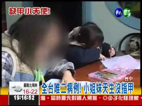 全台唯"二"! 她們天生沒指甲...