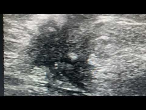 BIRADS 5 lesion breast - wide jagged borders , vertical orientation, architectural disruption