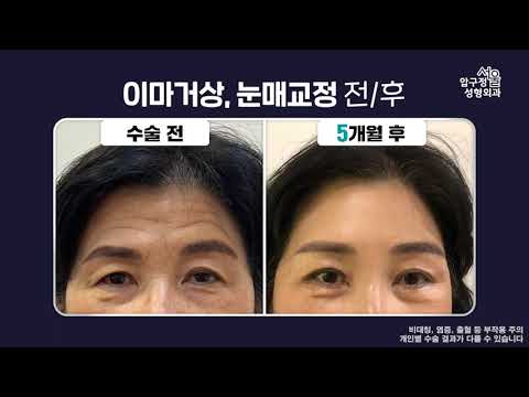 이마거상 전후 5개월 경과