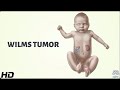 Wilms' Tumor: Everything You Need To Know