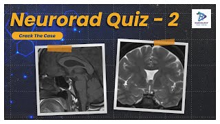 Neurorad Quiz Case Challenge - 2 | Dr.Umamaheswara Reddy.V