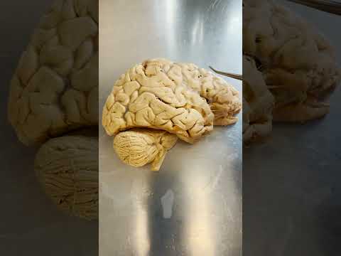 Alzheimers vs Dementia