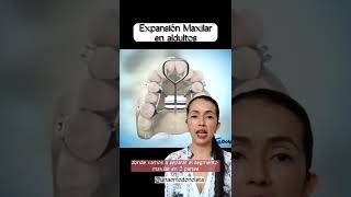 Expansión Maxilar quirúrgica en adultos