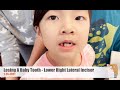 Katherine Losing A Baby Tooth Lower Right Lateral Incisor