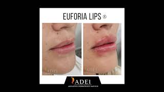 Euforia Lips - Ácido Hialurónico en Labios - ADEI - Aesthetics & Dermatology Institute