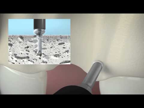 Animation SonicWeld Rx® Dental – Alveolenprotektor