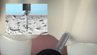 Animation SonicWeld Rx® Dental | Alveolenprotektor