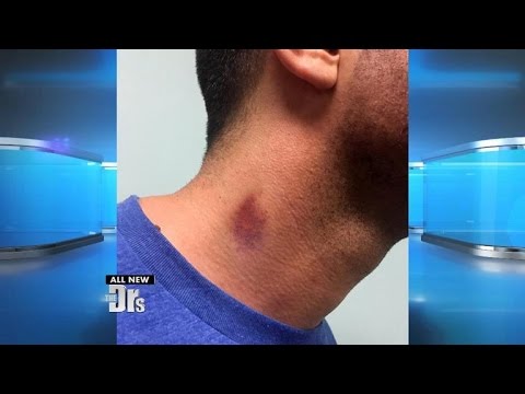 Do Hickeys Give Cancer