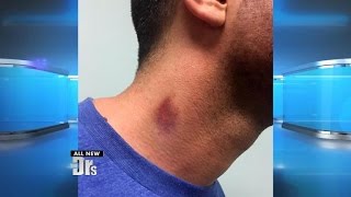 What the Health! Can Hickeys Kill