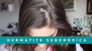 Problema Dermatite Seborroica: come la sto sconfiggendo