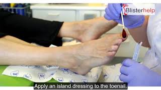 How to pop a blister under a toenail