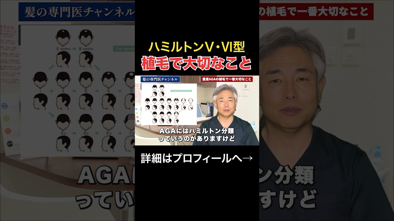 【ハミルトンⅤ・Ⅵ型】重度AGAの植毛で一番大切なこと#shorts #AGA#植毛#大切