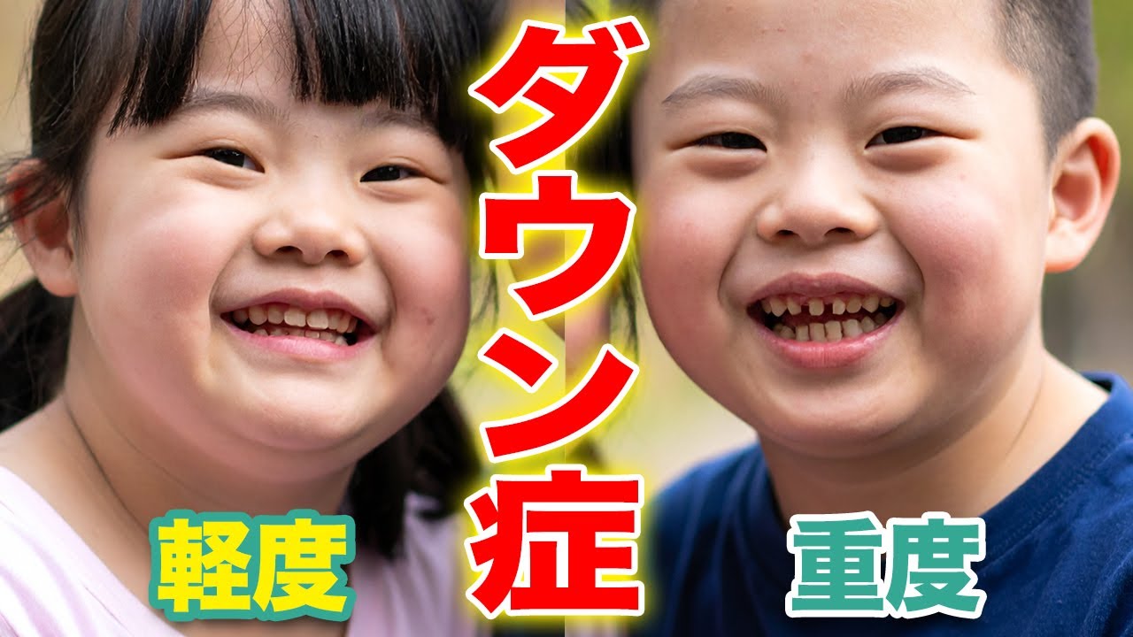 同じダウン症でもここまで違う？"重症度の差"にある意外な理由