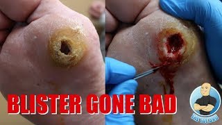 Surgery on Extreme Hole in Diabetic Foot with Neuropathy: Can Toe Bro Help Close the Hole?