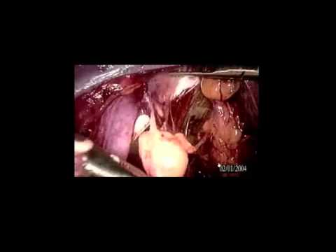 Laparoscopic Radical Hysterectomy