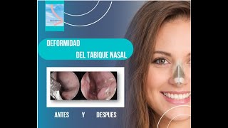 DESVIACIÓN DEL TABIQUE NASAL ANTES Y DESPUES