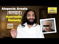 SUCCESSFULL ALOPECIA AREATA GANJAPAN AYURVEDIC REMEDY BY NITYANANDAM SHREE