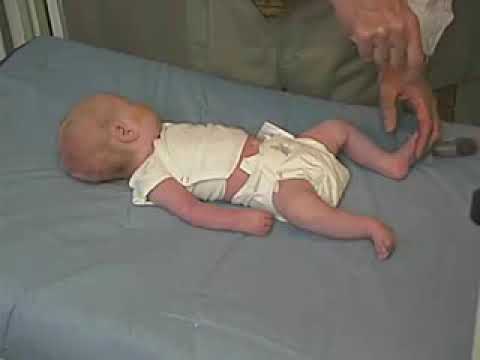 4.20 - Deep Tendon Reflexes - Newborn Abnormal - Infant Clinical Examination(MRCP)