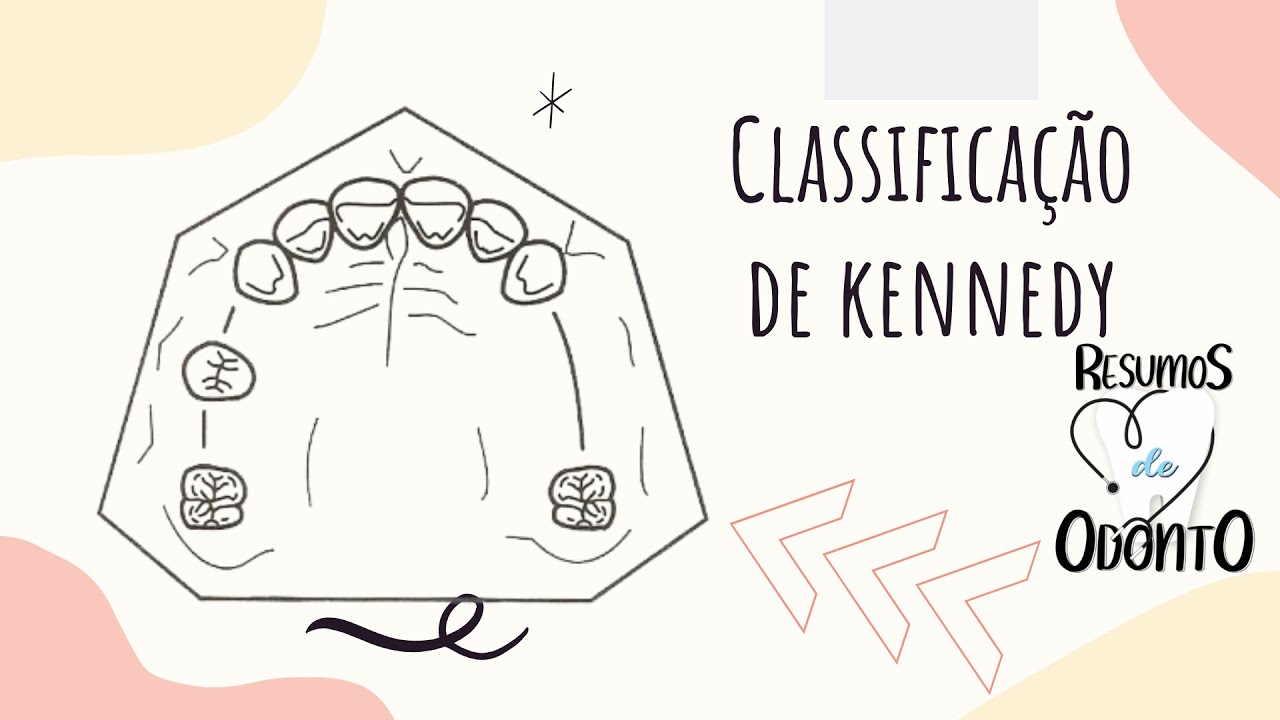 Classificação de Kennedy | Resumos de Odonto