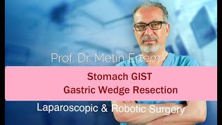 Miniaturka - Stomach GIST. Laparoscopic wedge resection. Metin Ertem MD.FACS