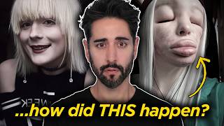 What Happened To Elva? The Hidden Crisis Behind DIY Fillers