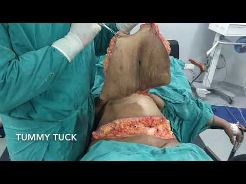 Patient Recovery Case — Video 23 (Tummy Tuck)