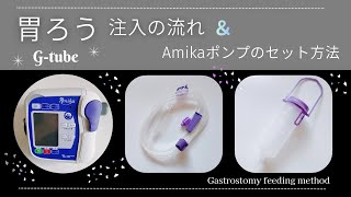 【実演】胃ろう注入の流れとアミカポンプのセット方法／G-Tube Feeding Flow & How to Set up Amika
