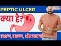 😨Peptic Ulcer(पेट में अल्सर) | Peptic Ulcer क्या है? | Peptic Ulcer लक्षण