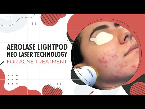 download lagu mp3 mp4 Aerolase Lightpod Neo, download lagu Aerolase Lightpod Neo gratis, unduh video klip Aerolase Lightpod Neo