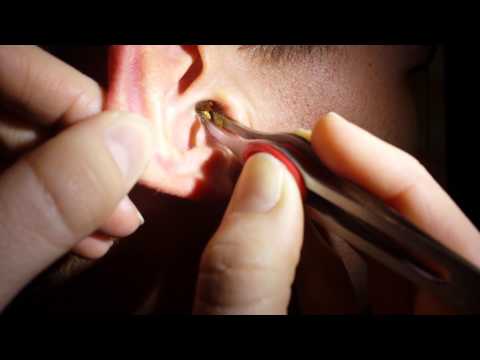 Removing impacted ear wax