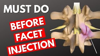Before Facet Injection Do This! | Lumbar Facet Injection