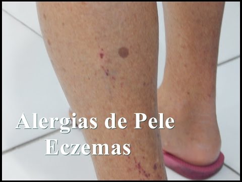 Medicina em psoríase dianteira Causas de neurodermatitis de doença