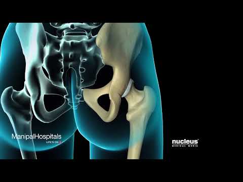 Total Hip Replacement Surgical Procedure| Best Orthopaedic Hospital in India