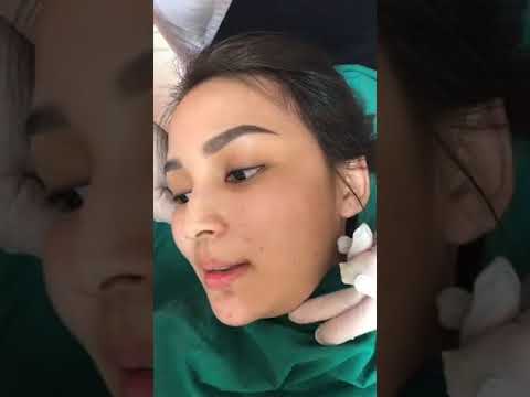 ร้อยไหม หน้าเรียว