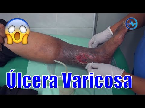 Ulcere ne-free în varicoză