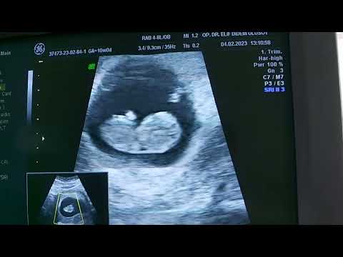 10 hafta gebelik izlemi ultrason görüntüsü