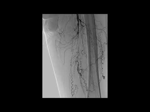 Challenging SFA Occlusion Case Solved by a Re-Entry Device