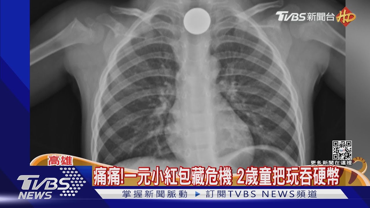 指著胸部喊痛痛!一元小紅包藏危機 2歲男童把玩吞硬幣