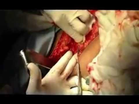 comment soigner une hernie inguinale sans opération