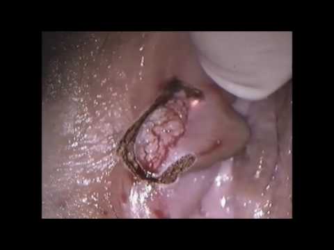 MCO 25plus – Applications in gynaecology