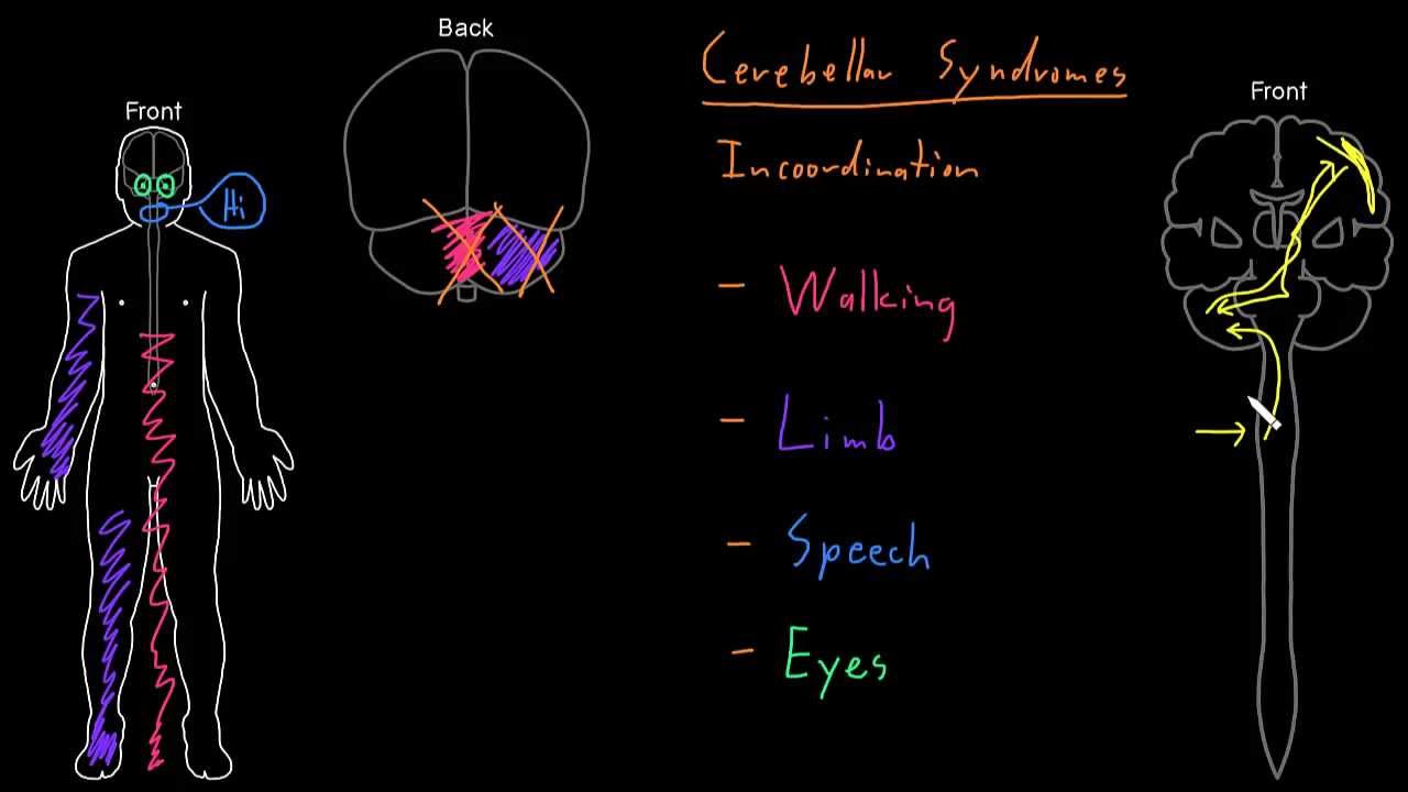 Syndrome: Cerebellar syndromes