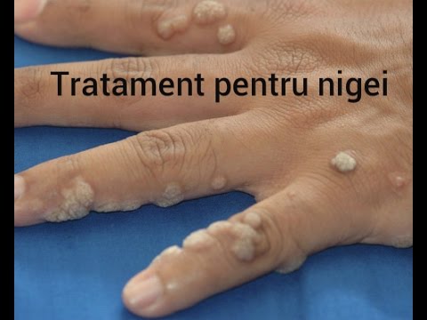 verucile genitale intrarea în vagin puternicloidoza hookworm ce este