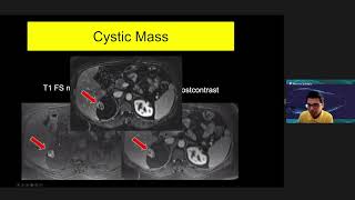 Cystic renal masses by Dr. Hersh Chandarana