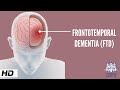 Frontotemporal Dementia, Causes, Signs and Symptoms, Diagnosis and Treatment.