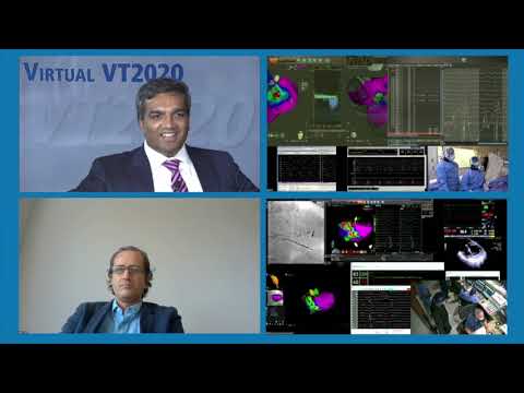 Dr. J David Burkhardt Performs Live Ischemic VT Ablation with Robotic EP at VT Symposium 2020