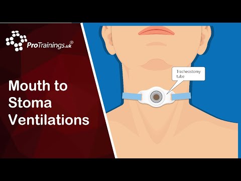 Mouth to Stoma Ventilations