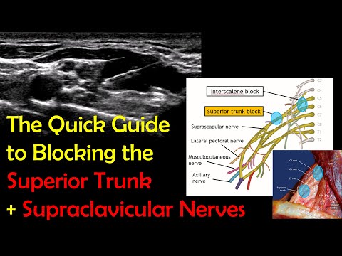 SUPERIOR TRUNK BLOCK - A 5-Minute "How-To" Guide