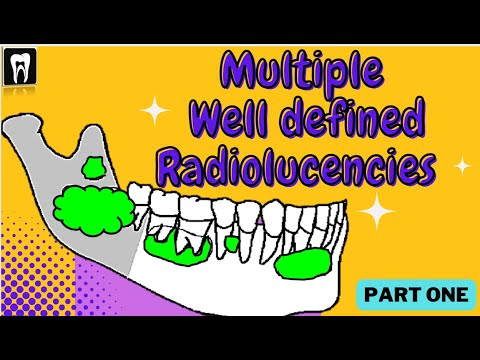 Multiple Separate Radiolucency With Well Defined Borders | Oral Radiology | Oral Pathology | OKC