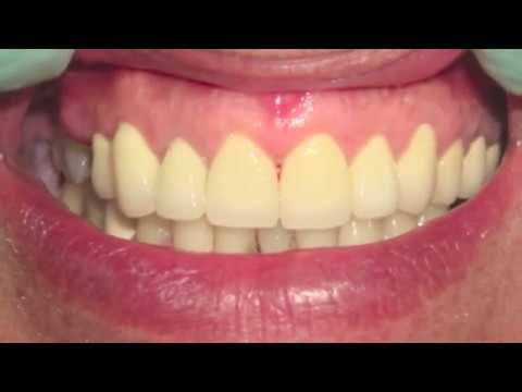 DENTIST AHMEDABAD LASER IMPLANT INDIA