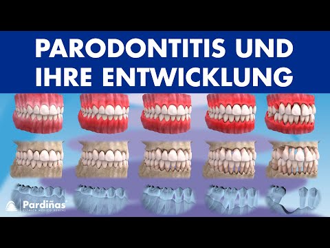 Zahnfleischentzündung, Parodontitis und ihre Entwicklung ©